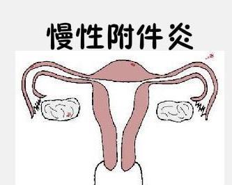 慢性附件炎是指女性内生殖器官,包括子宫,输卵管,卵巢及其周围的结缔