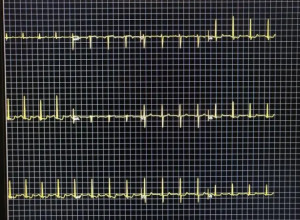 平板运动试验心电图图片