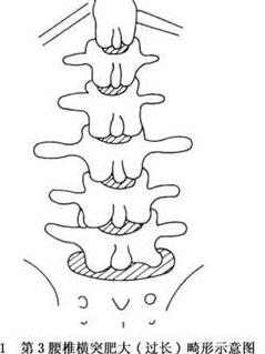 第3腰椎横突过长畸形