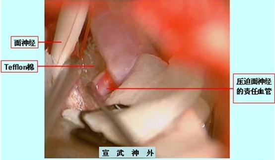 将特制的不可吸收“Tefflon棉”永久性植入