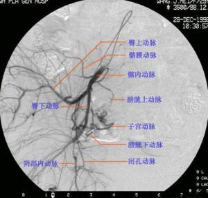 髂动脉造影,髂动脉造影适用于血管性病变如动脉狭窄,闭塞,动脉瘤,动