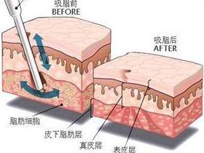 抽脂