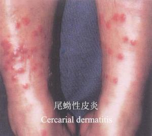 均是禽类或畜类血吸虫尾蚴侵入人体皮肤所引起的疾病