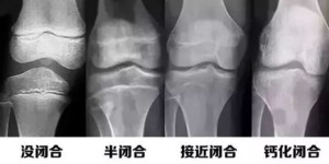 骨骼线