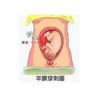 羊水穿刺