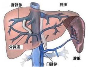 门静脉系统是肝的机能血管集合的统称,是由肠系膜上静脉和脾静脉汇合
