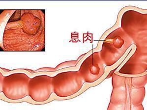 肿瘤性息肉