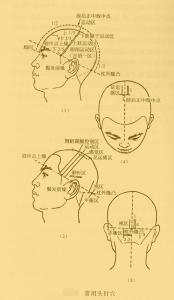 常用头皮针刺激部位图