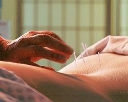 针灸实拍