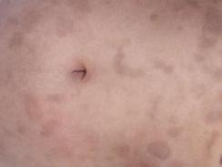 色素沉着用什么药比较好 0