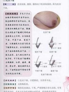 蒙氏结节