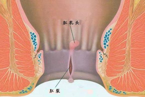 肛乳头 搜狗百科
