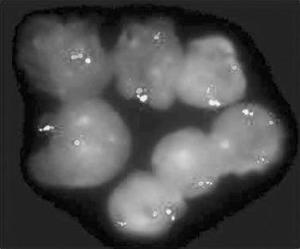 什么是基因突变导致肺癌 300