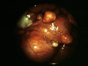 浆膜下子宫肌瘤 浆膜下子宫肌瘤