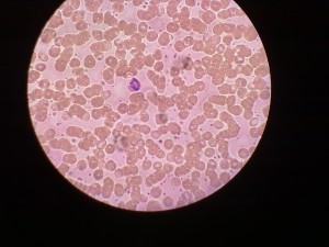 尿沉渣红细胞图片图片