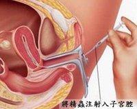 人工受精