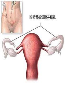 女性结扎