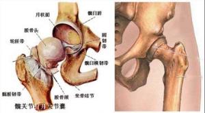 股骨头坏死