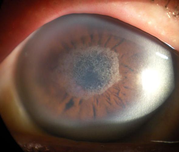 角膜环,也称intacs角膜环或角膜基质环,主要用于于圆锥角膜病,中低度