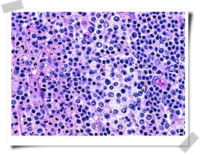 窦性组织细胞增生伴巨大淋巴结病