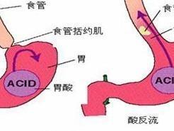 反流性食道炎