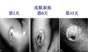 皮肤炭疽