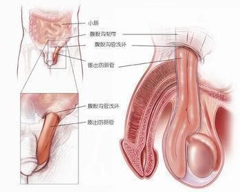 会阴疝 搜狗百科