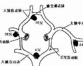 椎 基底动脉盗血综合征 搜狗百科