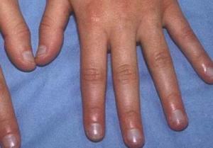 指甲呈现青紫色