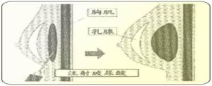 玻尿酸注射位置示意图