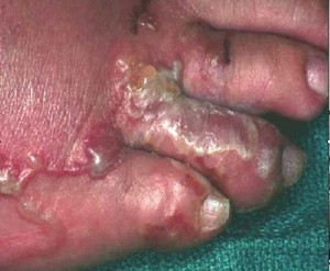 钩蚴性皮炎⑴钩蚴性皮炎:感染期蚴钻入皮肤后,数十分钟内患者局部皮肤