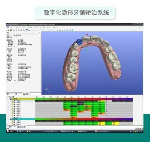 隐形牙齿矫正