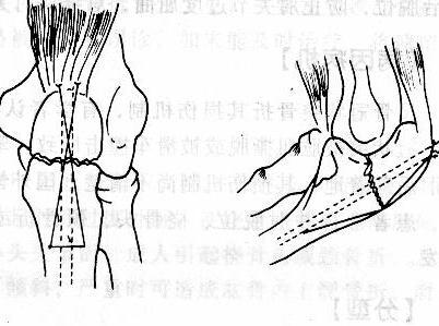 尺骨鷹嘴骨折