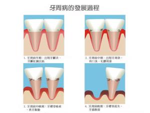 牙周病