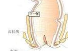 输卵管阻塞性不孕