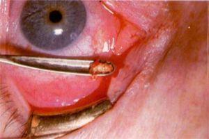 眼结石一颗手术过程图图片