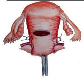 分娩24小时以后大出血者为晚期产后出血.