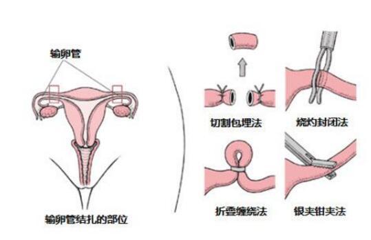 女性结扎手术图解图片