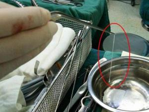 青蛙卵剥离手术