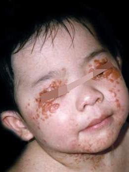 弥漫性婴儿纤维瘤病