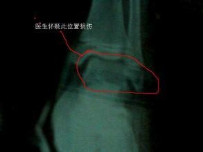踝关节骨折