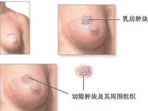 早期乳腺癌