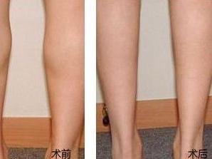瘦腿针