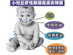 小儿丘疹性肢端皮炎
