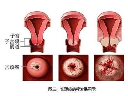 子宫癌 搜狗百科