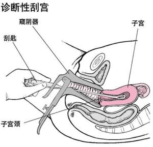 活检后宫颈恢复图图片