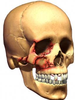 右侧上颌骨额突骨折图图片