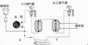 血液透析联合血液灌流