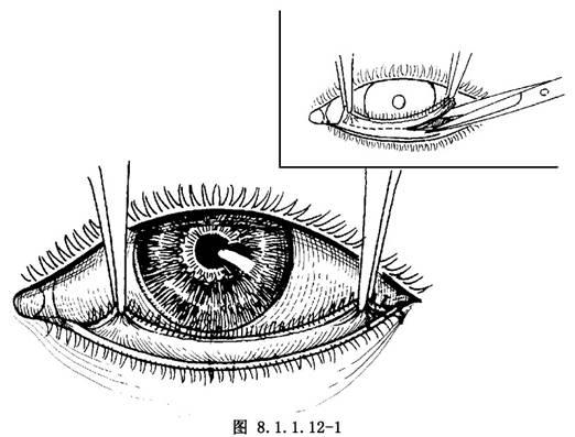 双行睫中的副睫毛少则3-5根,多者20余根,常见于双眼上,下睑,但也