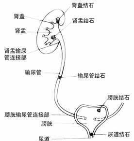 双输尿管结石能一次处理吗 0